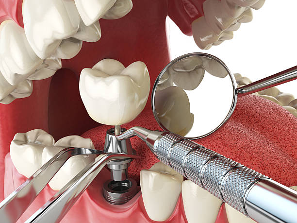 Best Emergency Treatment for Toothache in Bellevue, IL